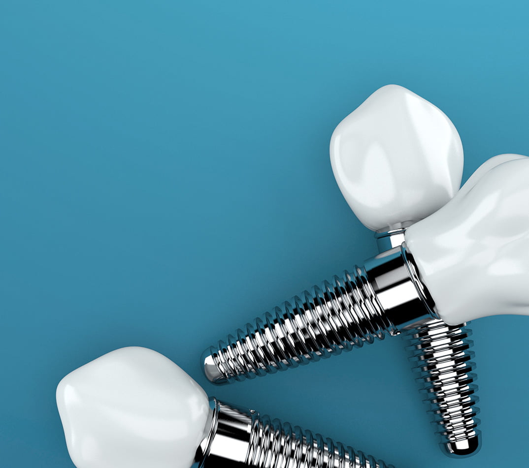 dental implants